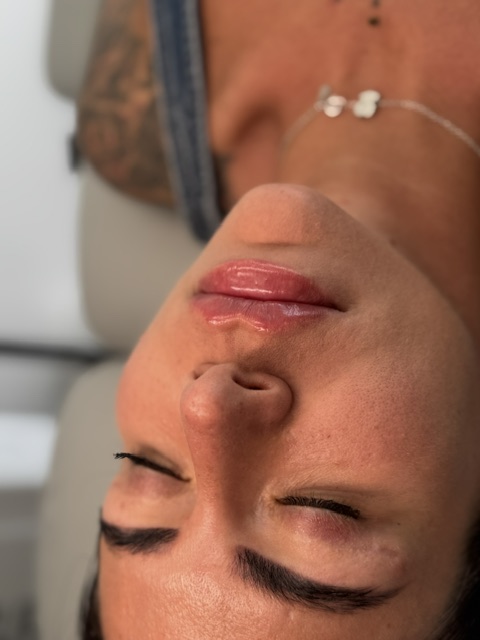 Powiększanie ust Krapkowice